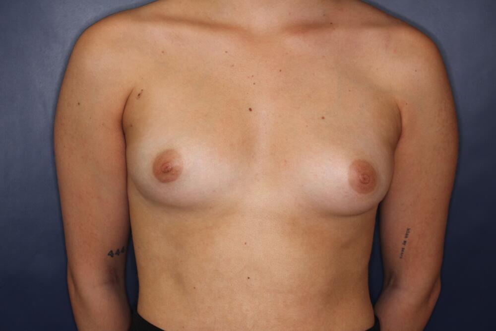 Breast Augmentation Before & After Image