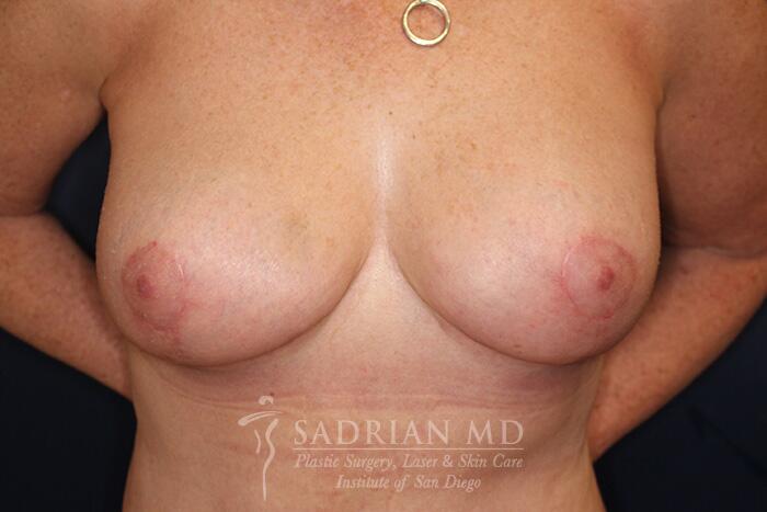 Breast Fat Transfer Before & After Image