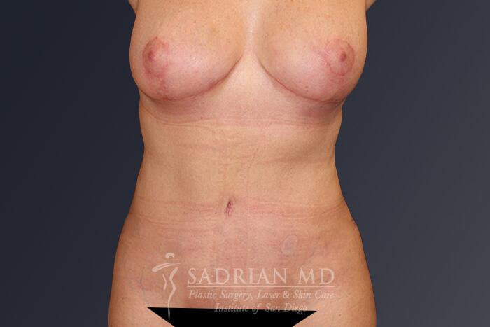 Breast Fat Transfer Before & After Image