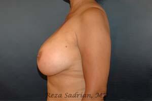 Breast Implant Removal Before & After Image