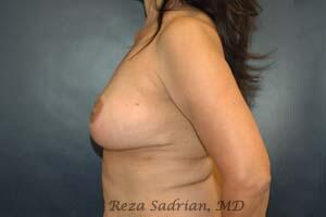 Breast Implant Removal Before & After Image