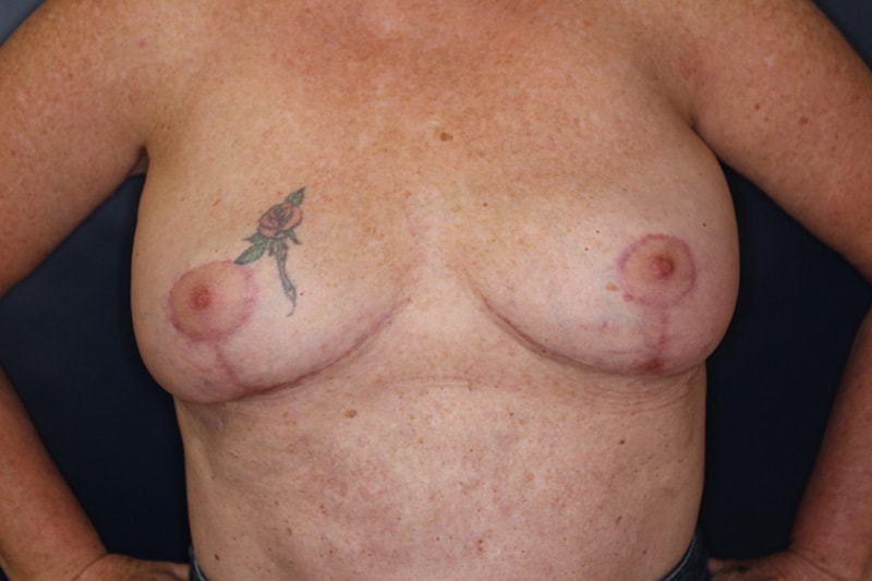 Breast Implant Removal Before & After Image