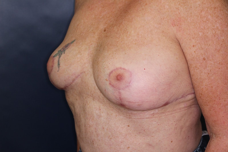 Breast Implant Removal Before & After Image