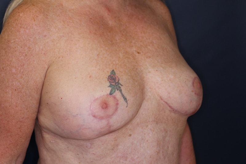 Breast Implant Removal Before & After Image