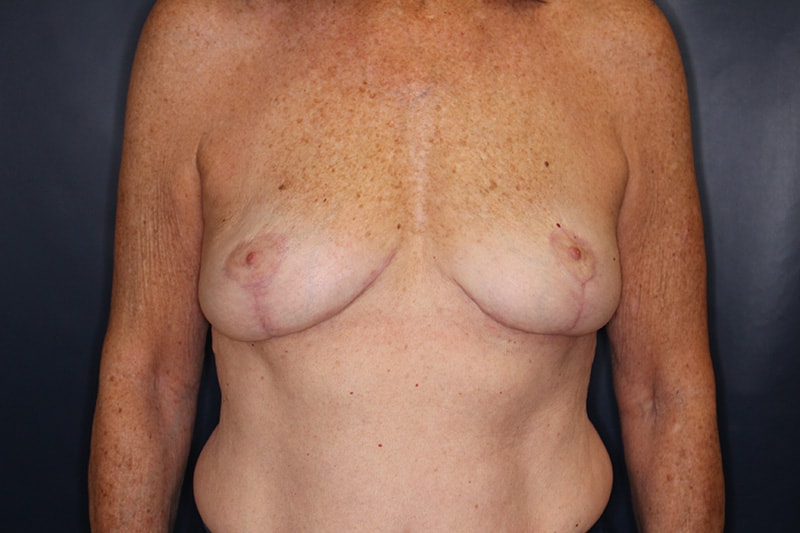 Breast Implant Removal Before & After Image