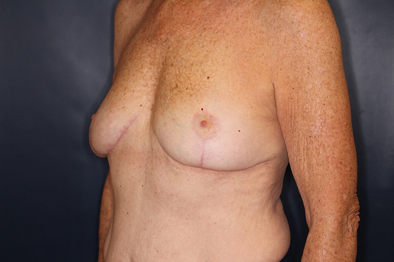 Breast Implant Removal Before & After Image