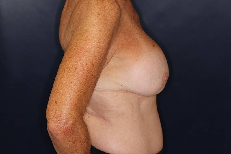 Breast Implant Removal Before & After Image