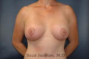 Breast Augmentation with Lift Before & After Image