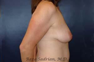 Breast Augmentation with Lift Before & After Image