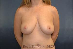 Breast Augmentation with Lift Before & After Image