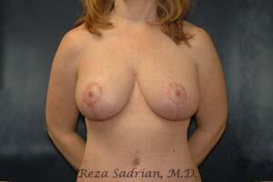 Breast Augmentation with Lift Before & After Image