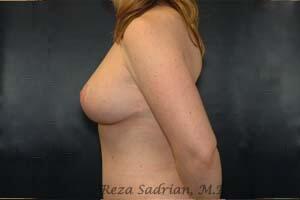 Breast Augmentation with Lift Before & After Image