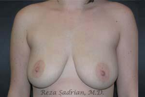 Breast Augmentation with Lift Before & After Image