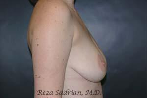 Breast Augmentation with Lift Before & After Image