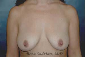 Breast Augmentation with Lift Before & After Image