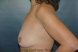 Breast Augmentation with Lift Before & After Image