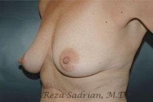 Breast Augmentation with Lift Before & After Image