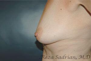 Breast Augmentation with Lift Before & After Image