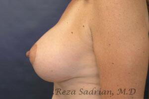 Breast Augmentation with Lift Before & After Image