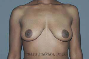 Breast Augmentation with Lift Before & After Image