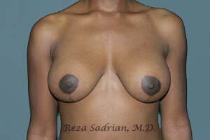 Breast Augmentation with Lift Before & After Image