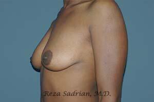 Breast Augmentation with Lift Before & After Image