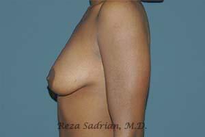 Breast Augmentation with Lift Before & After Image