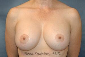 Breast Augmentation with Lift Before & After Image