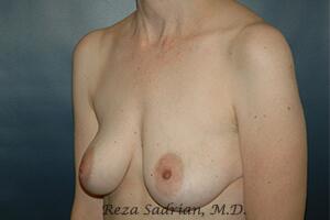 Breast Augmentation with Lift Before & After Image