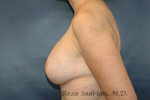 Breast Augmentation with Lift Before & After Image