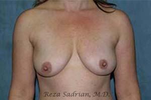 Breast Augmentation with Lift Before & After Image