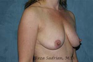 Breast Augmentation with Lift Before & After Image
