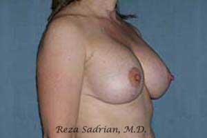 Breast Augmentation with Lift Before & After Image