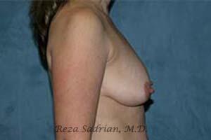 Breast Augmentation with Lift Before & After Image