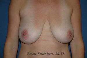 Breast Augmentation with Lift Before & After Image