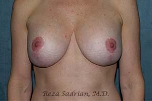 Breast Augmentation with Lift Before & After Image