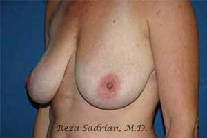 Breast Augmentation with Lift Before & After Image