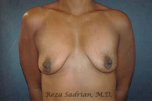 Breast Augmentation with Lift Before & After Image