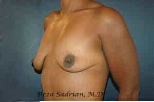 Breast Augmentation with Lift Before & After Image