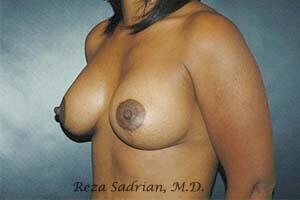 Breast Augmentation with Lift Before & After Image