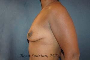 Breast Augmentation with Lift Before & After Image