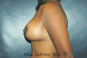 Breast Augmentation with Lift Before & After Image