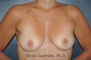 Breast Augmentation with Lift Before & After Image