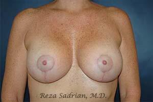 Breast Augmentation with Lift Before & After Image