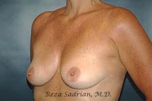 Breast Augmentation with Lift Before & After Image