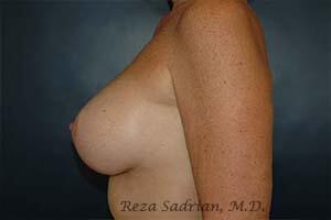 Breast Augmentation with Lift Before & After Image