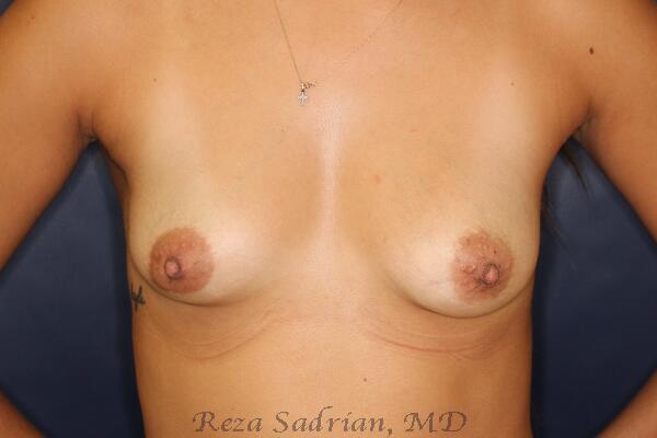 Breast Augmentation with Lift Before & After Image