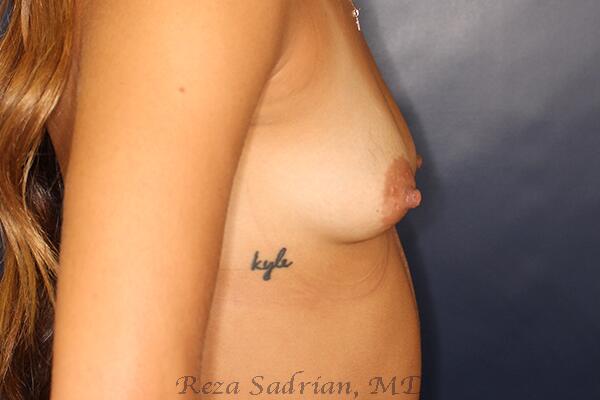 Breast Augmentation with Lift Before & After Image