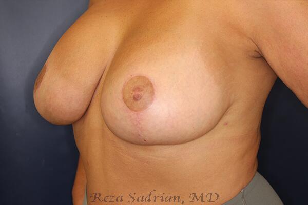 Breast Augmentation with Lift Before & After Image