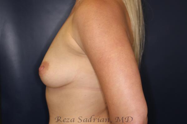 Breast Augmentation with Lift Before & After Image